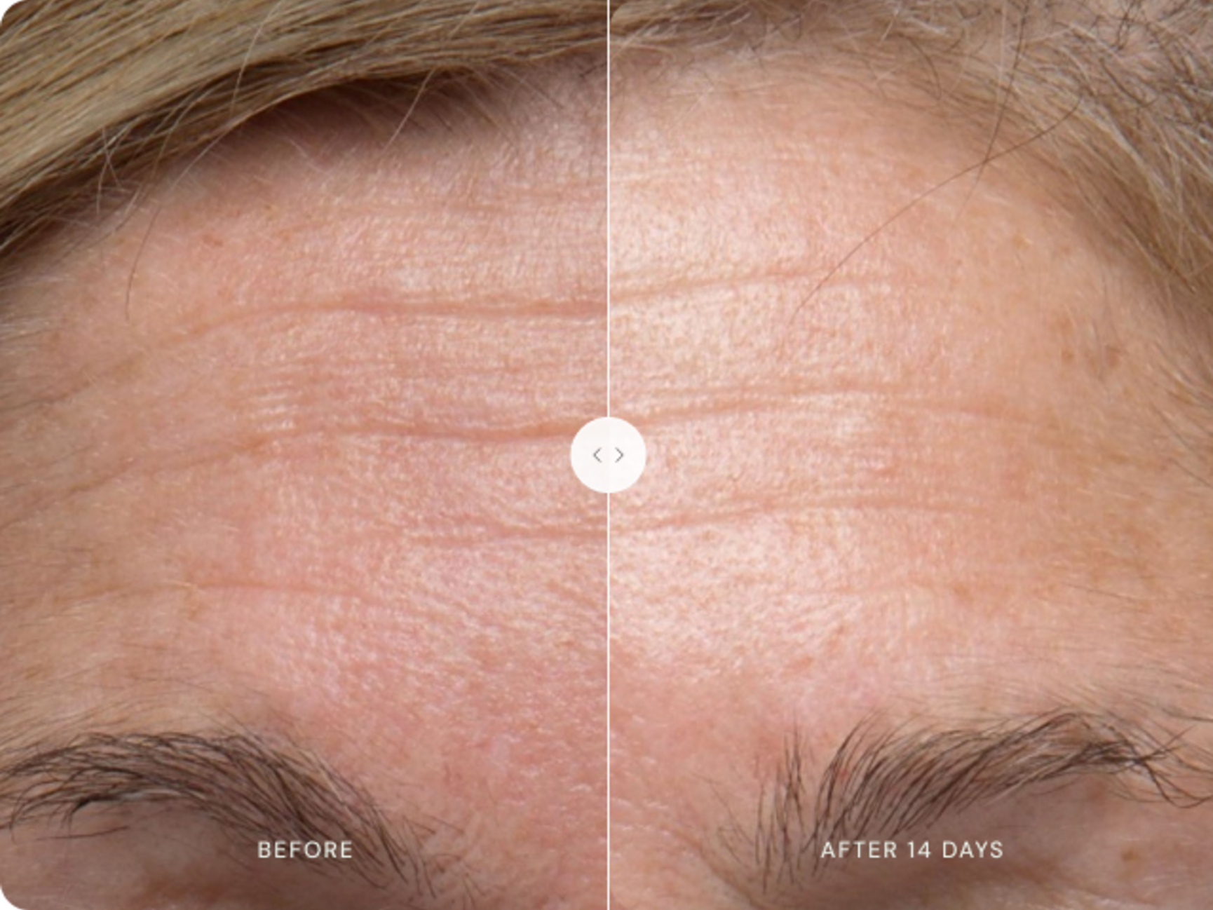 Before and after image of a forehead showing a reduction in wrinkles after 14 days.