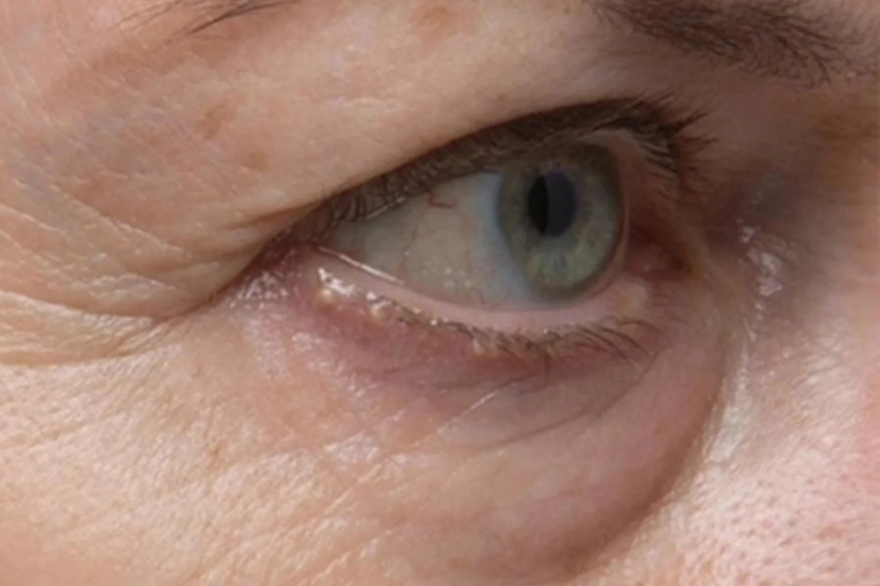 How to Get Rid of Crows Feet