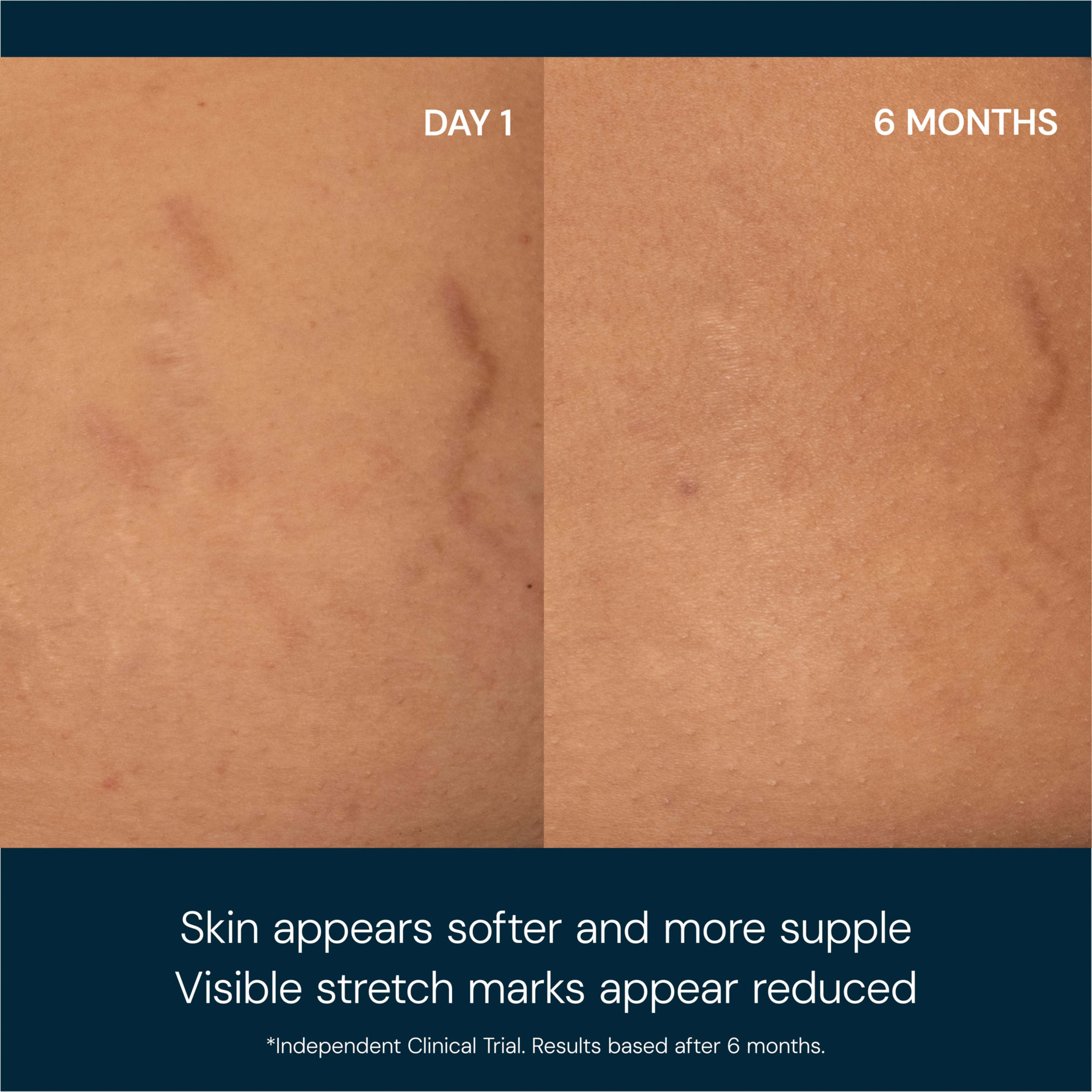 Side-by-side comparison of the same area of skin labelled "Day 1" and "6 months", showing stretch marks looking softer and less visible after 6 months. Caption states: "Skin appears softer and more supple. Visible stretch marks appear reduced. *Independent Clinical Trial. Results based after 6 months."