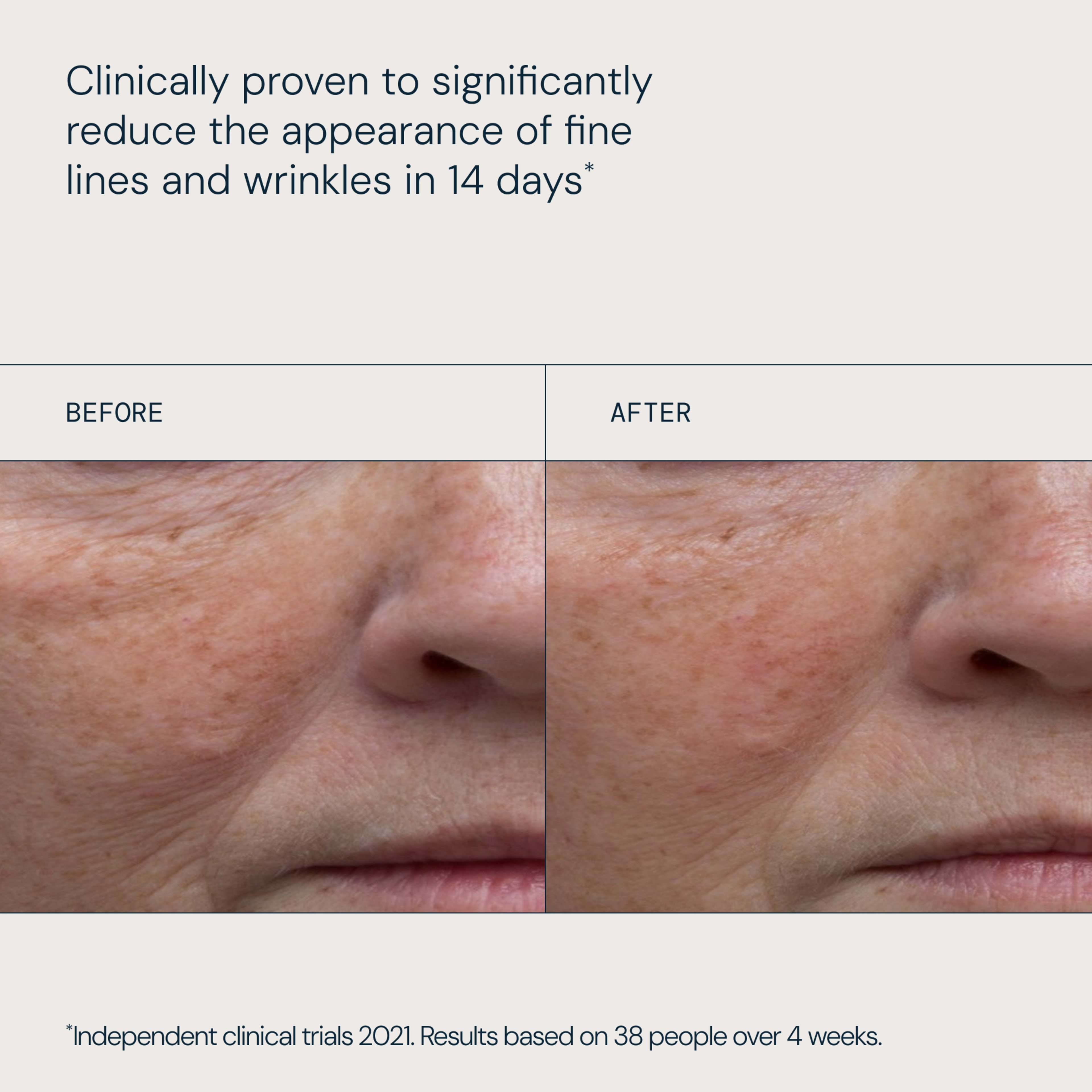 Clinically proven to significantly reduce the appearance of fine lines and wrinkles in 14 days. Split-screen close-up of a woman’s lower face labelled before and after, showing visibly smoother skin with fewer fine lines in the after image.